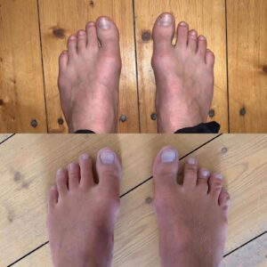 Vorher Nachher Vergleich Fußgesundheit